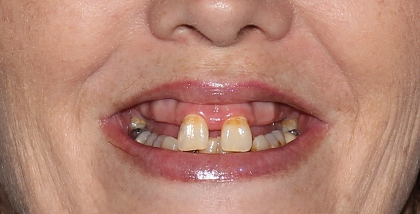 Partial Dentures Before And After Willmar MN 56201